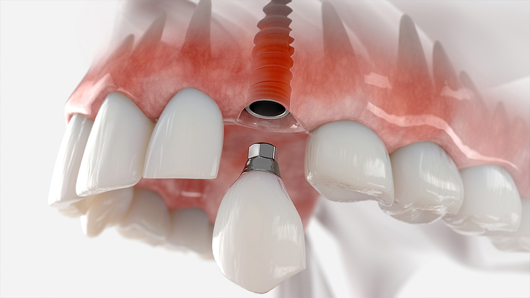Implant dentar la clinica de top – Cum sa alegi cea mai buna pentru tinev